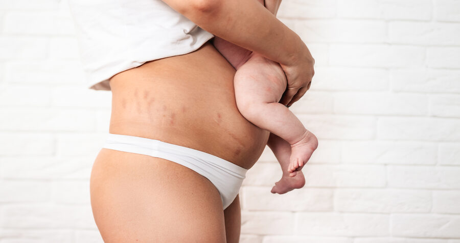 A baby's legs resting on their mother's postpartum belly